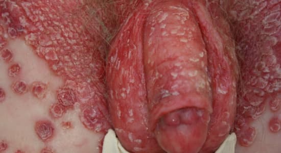Légère crise d'eczema