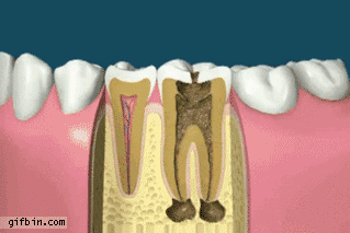 Comment remplacer une dent infectée