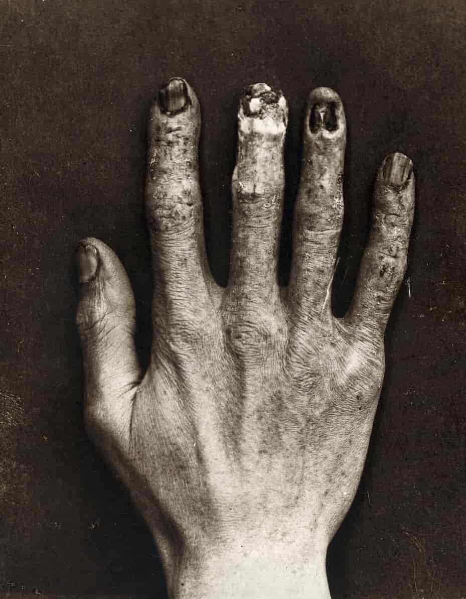 La main d'un ancien opérateur de machine à rayons X