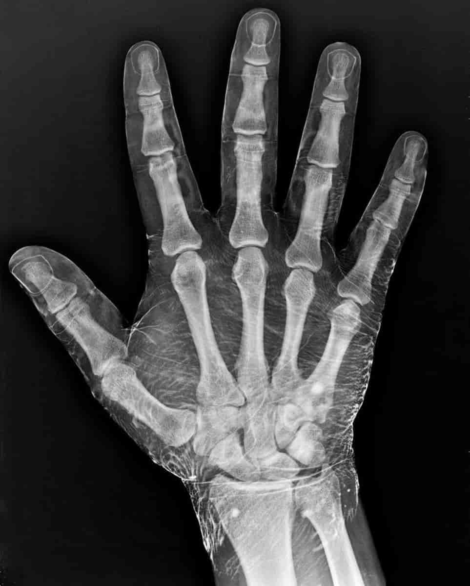 Radiographie d'une main après l'avoir plongée dans l'iode